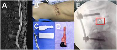 Investigating the feasibility and effectiveness of bacterial culture in negative pressure wound drainage fluid